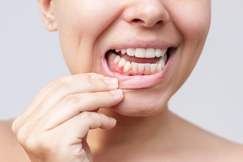 Gingivitis en Culleredo