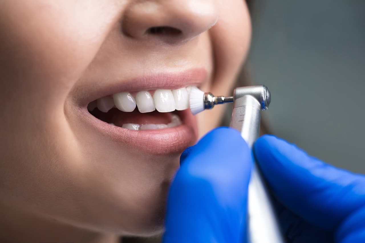 Limpieza dental